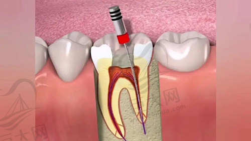 根管治疗