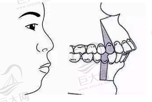 牙齿深覆合示范图