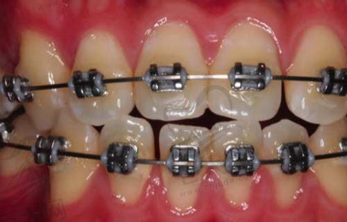 牙齿金属托槽矫正