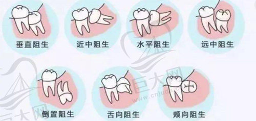 智齿阻生的种类