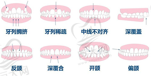 35岁还可以做牙齿矫正吗，需要做牙齿矫正的人看这