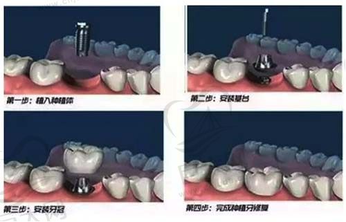 牙齿种植详细步骤
