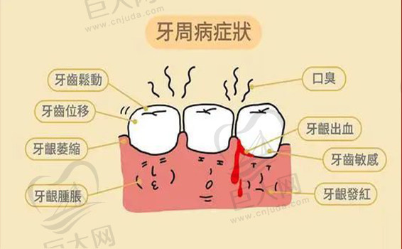 牙周病的症状