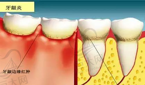 牙龈炎