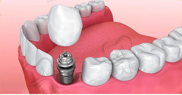 种植牙贵