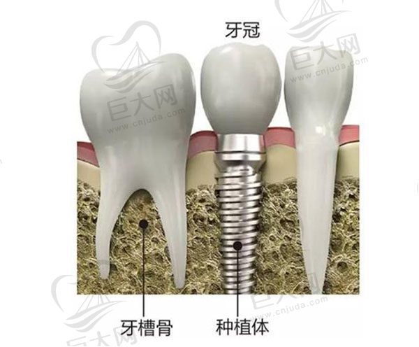 以后种牙价格会越来越便宜吗