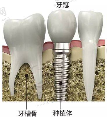 种植牙8000一般能用多久