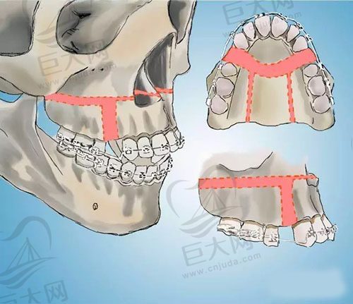 正颌手术