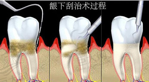 龈下刮治过程