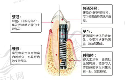 什么是种植牙