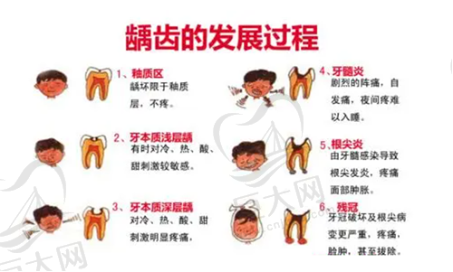 龋齿的发展过程