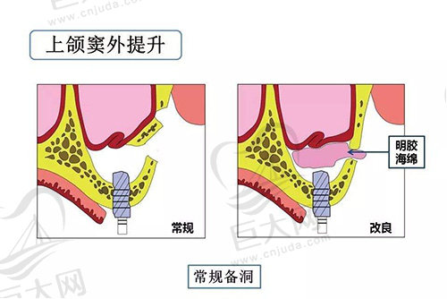 上颌窦外提升