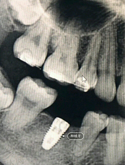 常德好大夫口腔种植牙