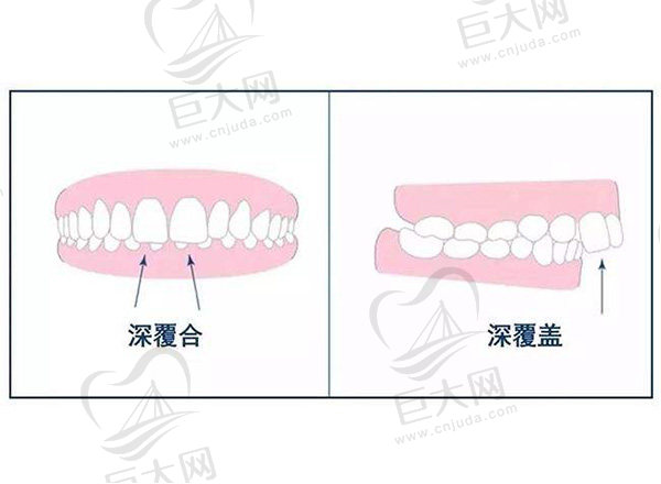 深覆合和深覆盖对比图片