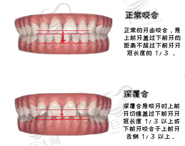 30岁深覆合有必要做矫正