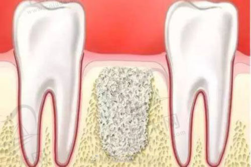 种植牙怎么判断要不要植骨粉