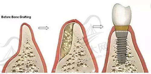 为什么有的种植牙需要植骨