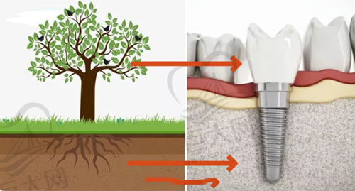 为什么有的种植牙需要植骨
