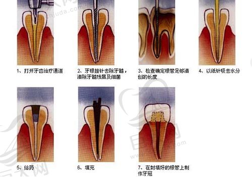 根管治疗的步骤过程