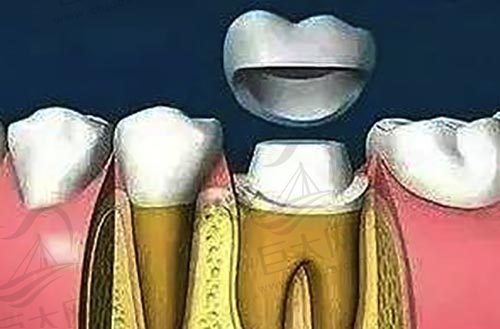 根管治疗后加牙冠保护