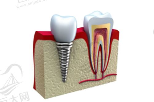 种植牙与真牙的切面图