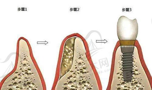 植牙骨粉过程