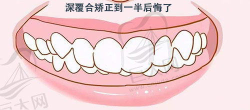 深覆合矫正到一半后悔了