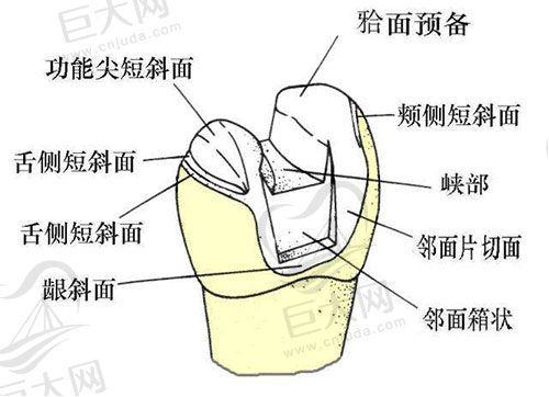 高嵌体结构图