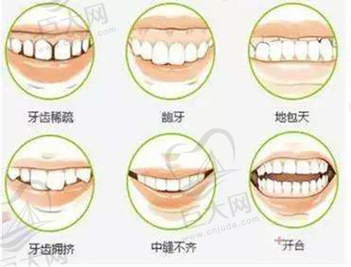 牙齿矫正适应症