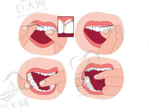 牙线清洁步骤