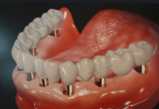西安未央中诺口腔半口种植牙示意图