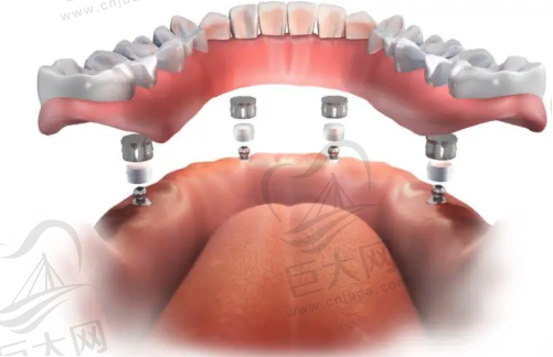 All-on-4种植牙技术