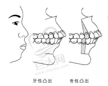 嘴凸的区别