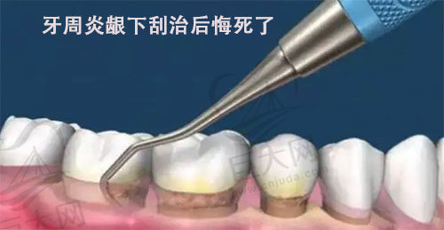 牙周炎龈下刮治后悔死了