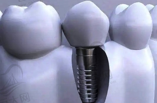 牙齿种植模型图示范