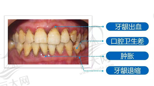 有牙周病还可以矫正牙齿吗