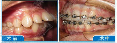 广西蓝天口腔医院正畸实例