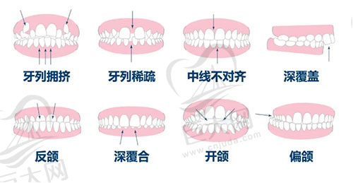 牙齿不齐的类型