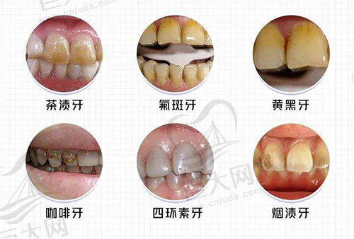 牙齿美白适应症