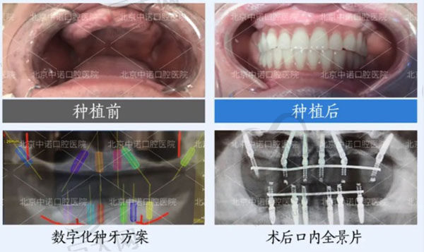 北京中诺口腔立得用微创种植牙术后