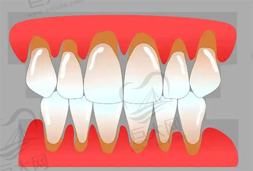 牙龈萎缩