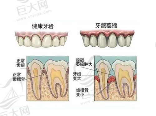 正常牙齿和牙龈萎缩对比图