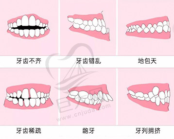 牙齿矫正适应症