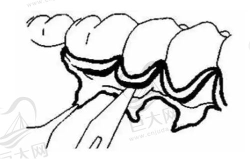 牙周翻瓣示意图