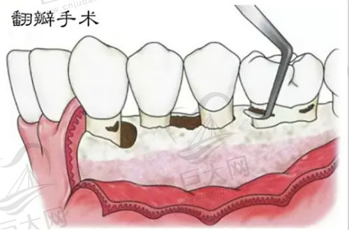 什么是牙周翻瓣