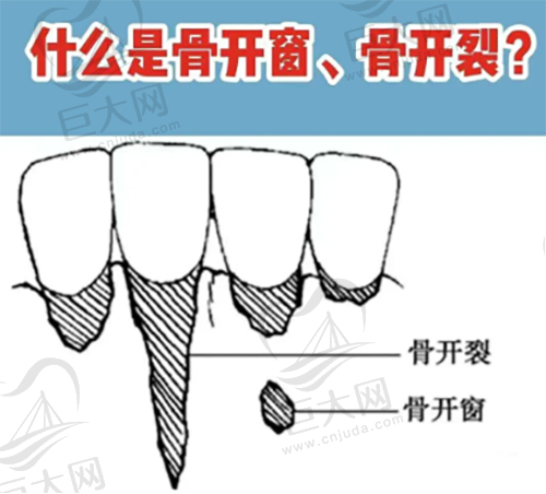 什么是骨开窗、骨开裂？