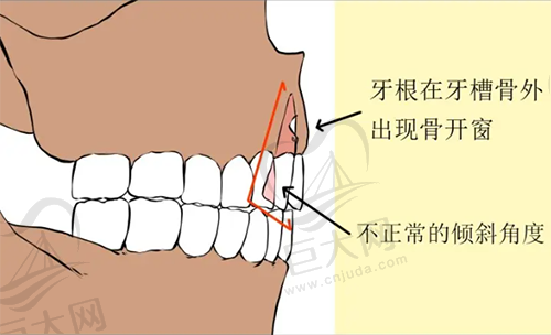 牙齿骨开窗