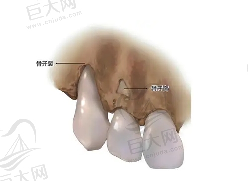 牙齿骨开窗开裂