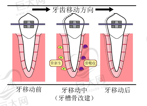 牙齿矫正牙槽骨改建示意图