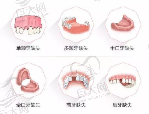 牙齿缺失